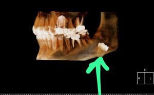 עקירה כירורגית של שן כלואה מהצוואר